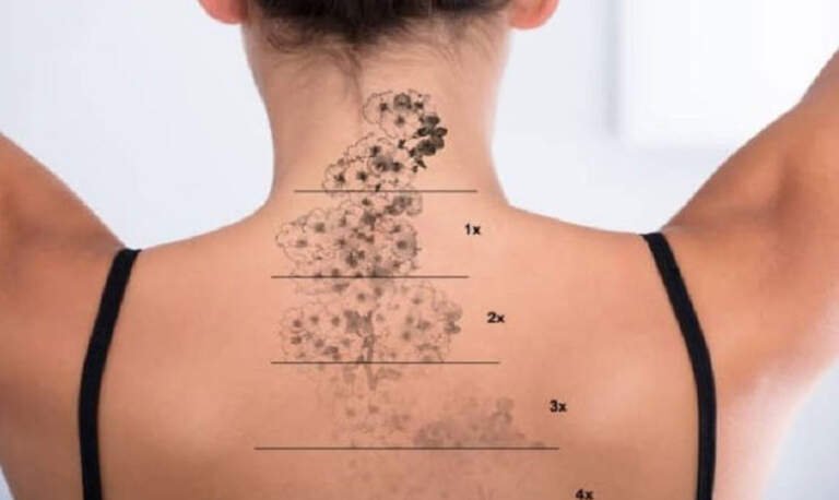 Tattoo Removal and Skin Health: How to Care for Your Skin Before, During, and After