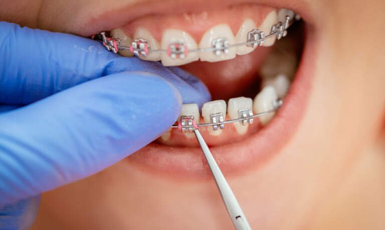 How to Manage Braces Maintenance and Avoid Common Issues