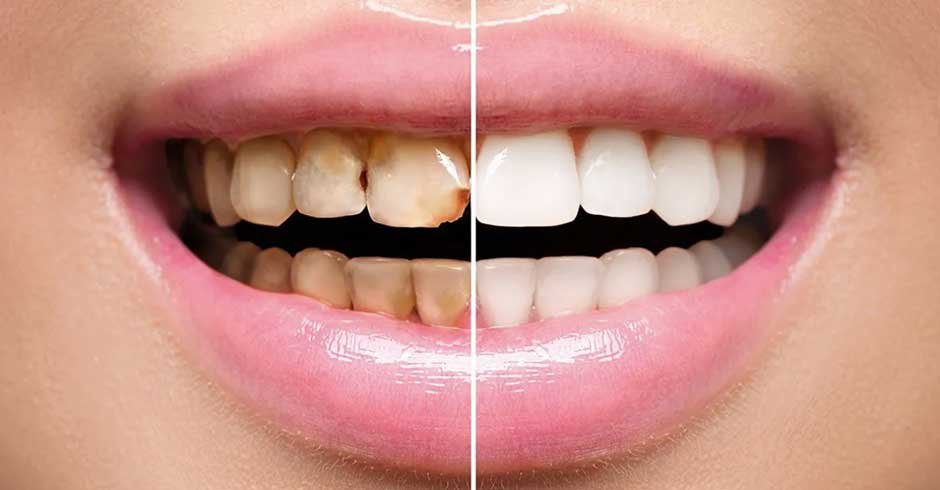 What are Dental Veneers