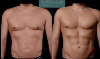 Vaser Hi-Def and Mid-Def Liposuction: A Guide to improved Body Contouring