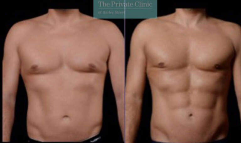 Vaser Hi-Def and Mid-Def Liposuction