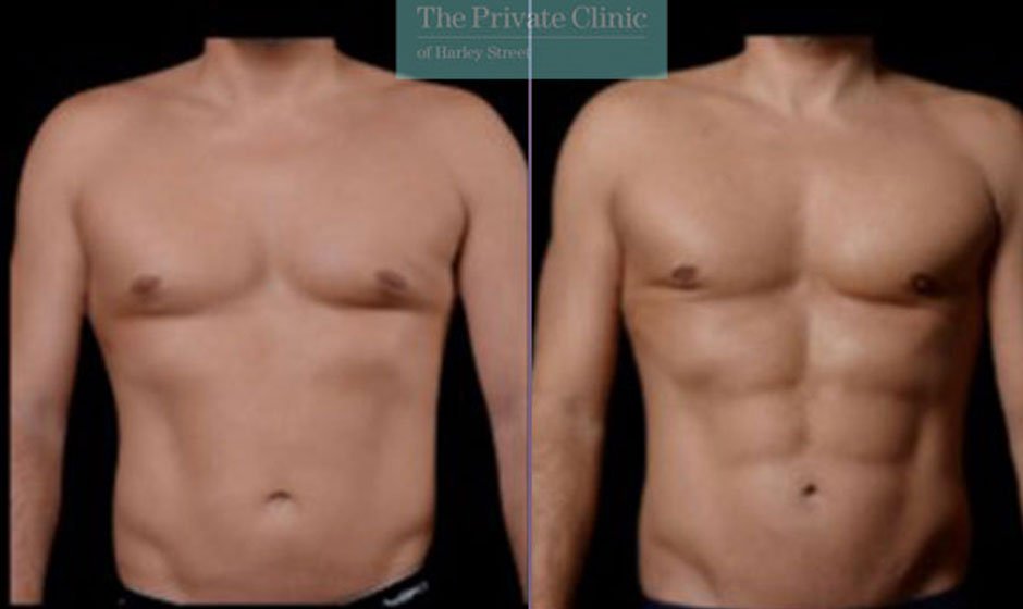 Vaser Hi-Def and Mid-Def Liposuction: A Guide to improved Body Contouring