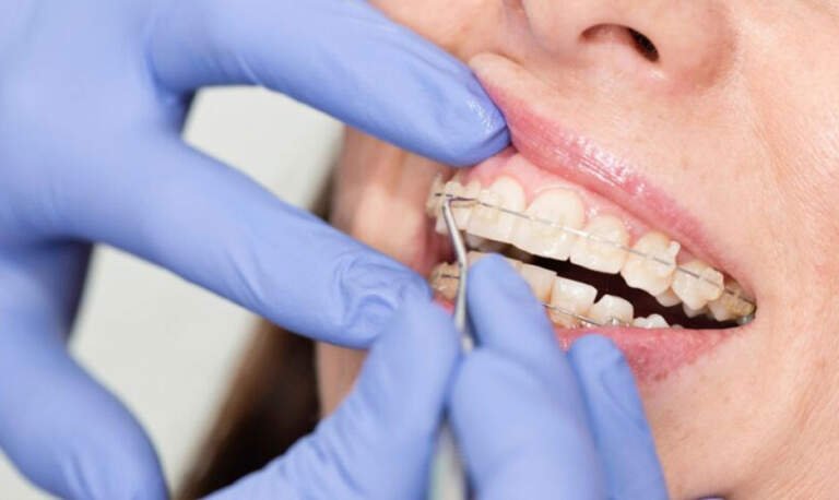 Looking for the Best Orthodontist in South Surrey? Here’s What You Need to Know