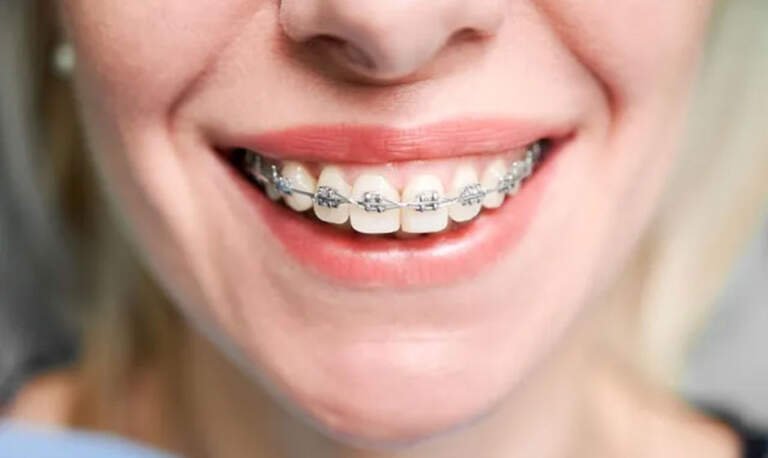 How Various Braces and Retainers Ensure Lasting Dental Success in Winnipeg