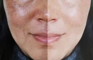 Is Microneedling a Good Solution for Uneven Skin Tone?