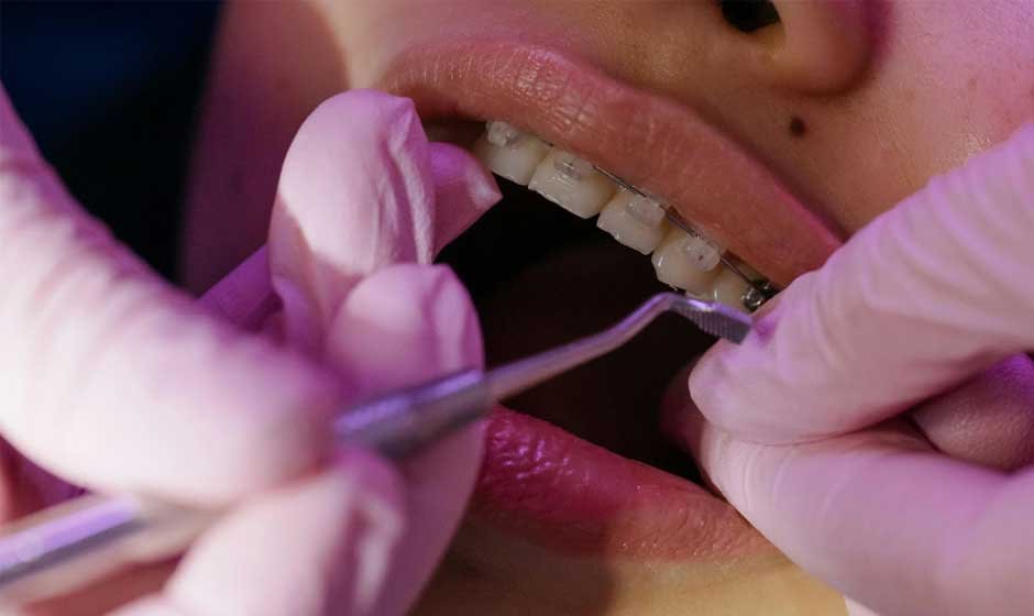 Understanding the Benefits of Braces for a Healthier Smile