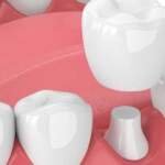 How Dental Crowns Restore Your Smile: Procedure and Aftercare Tips