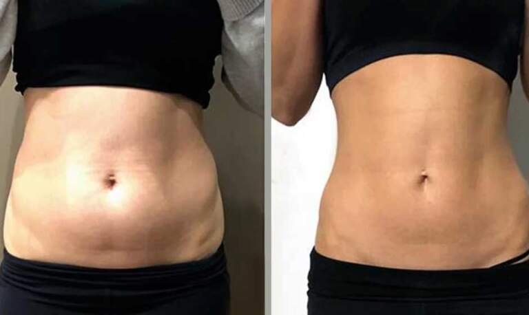 How Much Does Fat Freezing Cost in Australia? A 2025 Price Guide