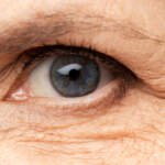 Signs-of-Accelerated-Cataract-Progression-in-Aging-Eyes